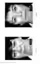 Fig. 07 - ENHANCED LIGHT BASED LIPOPLASTY