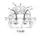 Fig. 08 - EXTRACRANIAL IMPLANTABLE DEVICES, SYSTEMS AND METHODS FOR THE TREATMENT OF MEDICAL DISORDERS