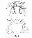 Fig. 09 - EXTRACRANIAL IMPLANTABLE DEVICES, SYSTEMS AND METHODS FOR THE TREATMENT OF MEDICAL DISORDERS