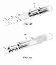 Fig. 03 - Deep brain stimulation current steering with split electrodes