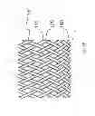 Fig. 03 - STENT WITH ELASTOMERIC ELEMENTS