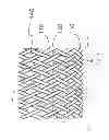 Fig. 07 - STENT WITH ELASTOMERIC ELEMENTS