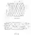 Fig. 08 - STENT WITH ELASTOMERIC ELEMENTS