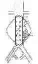 Fig. 01 - Devices and methods for treatment of vascular aneurysms