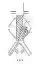 Fig. 08 - Devices and methods for treatment of vascular aneurysms