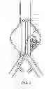 Fig. 10 - Devices and methods for treatment of vascular aneurysms