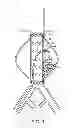 Fig. 11 - Devices and methods for treatment of vascular aneurysms