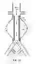 Fig. 14 - Devices and methods for treatment of vascular aneurysms