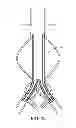 Fig. 15 - Devices and methods for treatment of vascular aneurysms