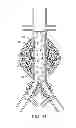 Fig. 16 - Devices and methods for treatment of vascular aneurysms