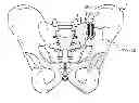 Fig. 01 - Sacroiliac joint implant system