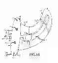 Fig. 09 - Sacroiliac joint implant system