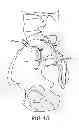 Fig. 19 - Sacroiliac joint implant system