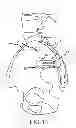 Fig. 20 - Sacroiliac joint implant system