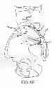 Fig. 22 - Sacroiliac joint implant system