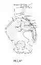 Fig. 23 - Sacroiliac joint implant system