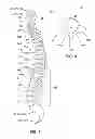 Fig. 04 - Interbody cage for spinal fusion and method of implanting interbody cages into spines