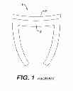 Fig. 02 - Concave resurfacing prosthesis kit