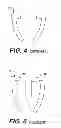 Fig. 04 - Concave resurfacing prosthesis kit