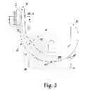 Fig. 04 - KNEE PROSTHESIS ASSEMBLY HAVING PROPORTIONAL TROCHLEAR GROOVE GEOMETRY