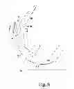 Fig. 06 - KNEE PROSTHESIS ASSEMBLY HAVING PROPORTIONAL TROCHLEAR GROOVE GEOMETRY