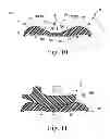 Fig. 09 - KNEE PROSTHESIS ASSEMBLY HAVING PROPORTIONAL TROCHLEAR GROOVE GEOMETRY