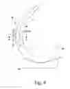 Fig. 08 - KNEE PROSTHESIS ASSEMBLY HAVING PROPORTIONAL CORONAL GEOMETRY
