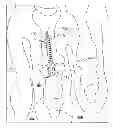 Fig. 01 - Tapered, cylindrical cruciform hammer toe implant and method