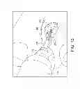 Fig. 08 - Tapered, cylindrical cruciform hammer toe implant and method