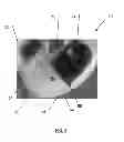 Fig. 05 - Accessory with integrated impact detection device for a head-worn member