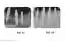 Fig. 02 - Method of surface treatment for zirconia dental implants
