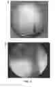 Fig. 03 - Methods and devices suitable for improved reattachment of detached cartilage to subchondral bone