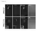Fig. 15 - Methods of detecting amyotrophic lateral sclerosis (ALS)