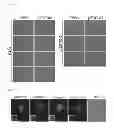 Fig. 16 - Methods of detecting amyotrophic lateral sclerosis (ALS)
