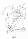 Fig. 02 - Combination heart assist systems, methods, and devices