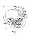 Fig. 04 - Implantable article and method