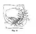 Fig. 10 - Implantable article and method
