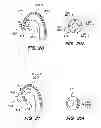 Fig. 16 - METHOD OF ANCHORING PULLWIRE DIRECTLY ARTICULATABLE REGION IN CATHETER