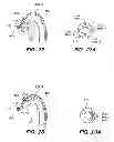 Fig. 17 - METHOD OF ANCHORING PULLWIRE DIRECTLY ARTICULATABLE REGION IN CATHETER