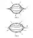 Fig. 09 - Bendable catheter arms having varied flexibility