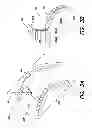 Fig. 04 - SUPINE BREAST MRI