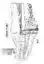 Fig. 10 - NEBULIZER THAT IS ACTIVATED BY NEGATIVE INSPIRATORY PRESSURE