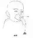 Fig. 19 - NEBULIZER THAT IS ACTIVATED BY NEGATIVE INSPIRATORY PRESSURE