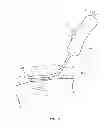 Fig. 03 - DEVICE AND METHOD FOR SALVAGING MYOCARDIUM FOLLOWING HEART ATTACK