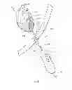 Fig. 04 - DEVICE AND METHOD FOR SALVAGING MYOCARDIUM FOLLOWING HEART ATTACK