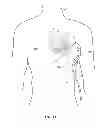 Fig. 09 - DEVICE AND METHOD FOR SALVAGING MYOCARDIUM FOLLOWING HEART ATTACK
