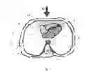 Fig. 02 - Circulatory flow restoration device