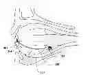 Fig. 01 - Device for adjusting the intraocular pressure