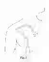 Fig. 02 - Selectively positionable catheter cuff