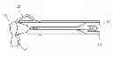 Fig. 01 - Catheter assembly